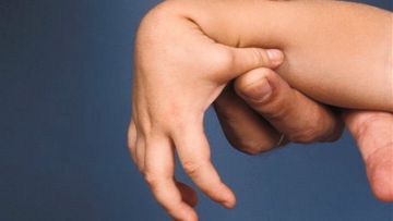 Edwards Syndrome