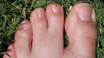 Edwards Syndrome