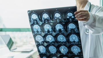Encephalitis