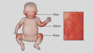 bullous impetigo in children