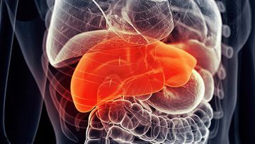 Alpha -1 Antitrypsin Deficiency