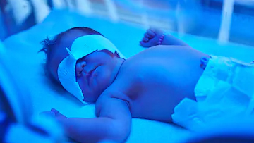 Jaundice in Newborn