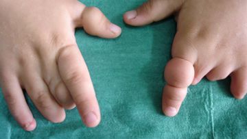 Amniotic Bands