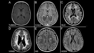 Leukodystrophies - MRI
