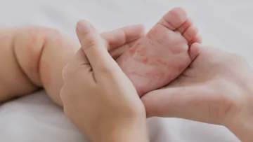 Measles