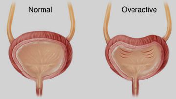 Neurogenic Bladder