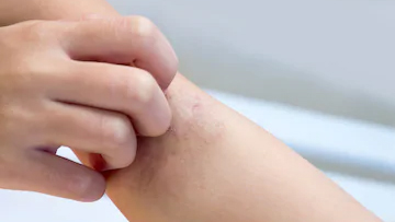 Scabies