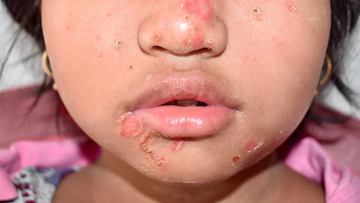Staphylococcal scaldeWd skin syndrome and toxic shock syndrome.
