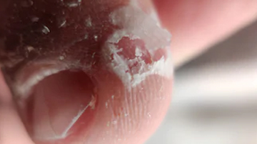 Staphylococcal Scaled Skin Syndrome