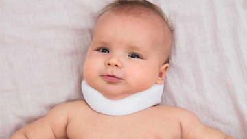 Torticollis