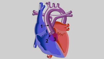 Truncus Arteriosus X Ray