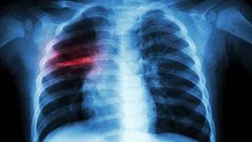 Tuberculosis of The Spine