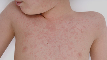 Urticaria (Hives) and Angioedema