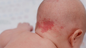 Vascular Birthmarks