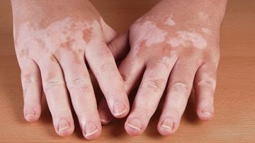 Vitiligo