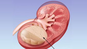 Wilm's Tumor (Nephroblastoma)