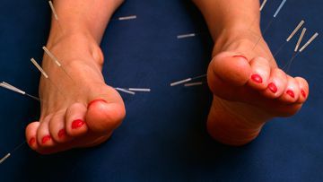 Acupressure and Acupuncture