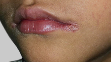 Iron Deficiency in Children