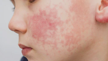 Skin Diseases: Diseases and Conditions | Pediatric Oncall