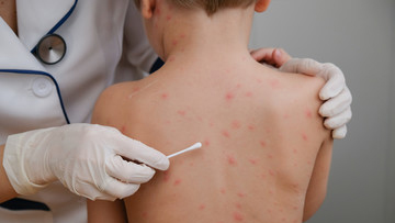 Chickenpox