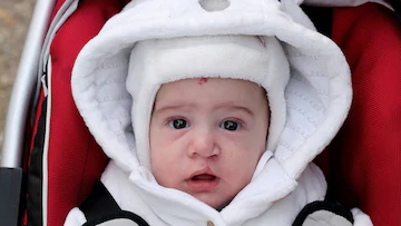 Cleft Lip And Cleft Palate