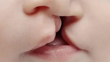 Cleft Lip And Cleft Palate