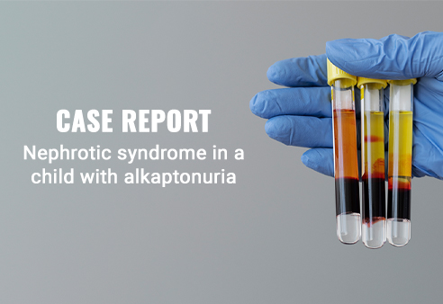 Nephrotic syndrome in a child with alkaptonuria