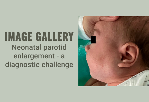 Neonatal parotid enlargement - a diagnostic challenge