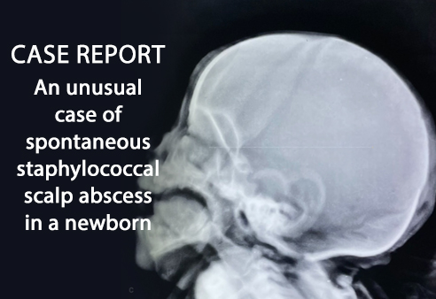 An unusual case of spontaneous staphylococcal scalp abscess in a newborn : A case report