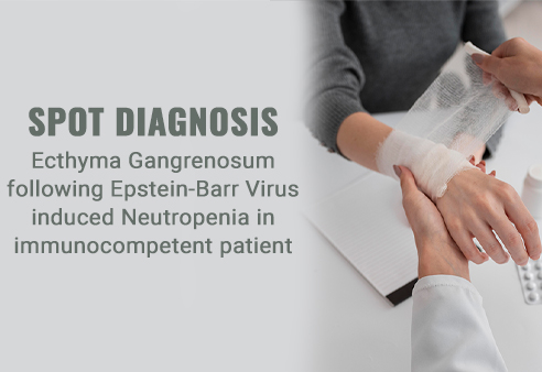 Ecthyma Gangrenosum following Epstein-Barr Virus induced Neutropenia in immunocompetent patient