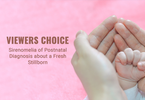 Sirenomelia of Postnatal Diagnosis about a Fresh Stillborn
