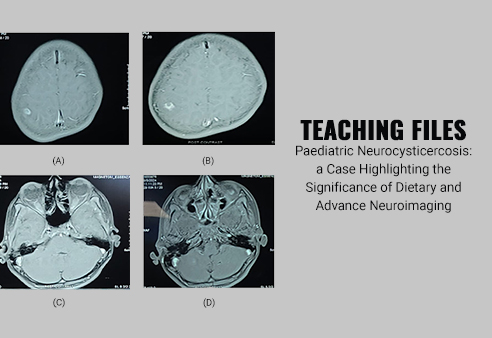 Paediatric Neurocysticercosis: a Case Highlighting the Significance of Dietary and Advance Neuroimaging