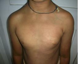 <b>Picture 1: Multiple maculopapular lesion over trunk and limbs</b>
