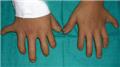 Ellis Van Creveld Syndrome