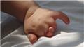 Amniotic Bands