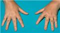 Selective Iga Deficiency