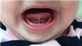 Tongue Tie in Infants