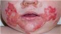 Zinc Deficiency in Children