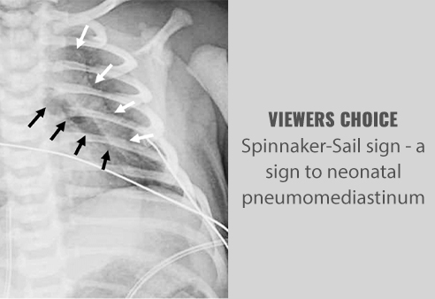 Spinnaker-Sail sign - a sign to neonatal pneumomediastinum